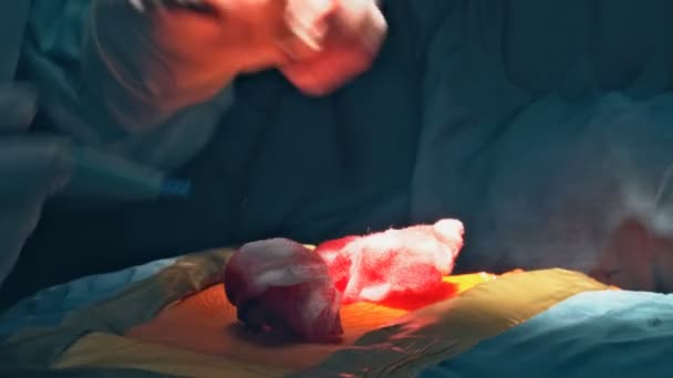 Necesario Realizar Una Disección Torácica Para Realizar Una Cirugía Corazón — Vídeos de Stock