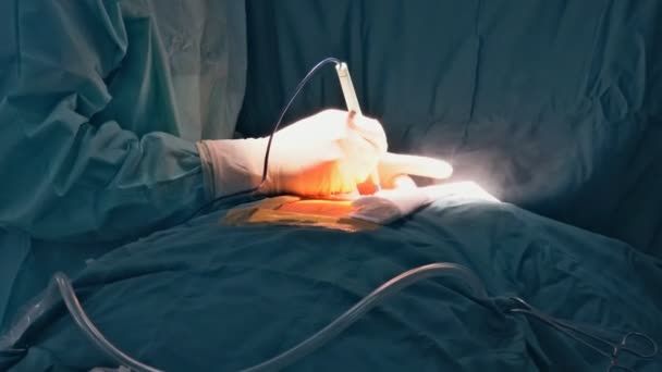 Para Realizar Una Cirugía Corazón Abierto Requiere Disección Tórax — Vídeos de Stock