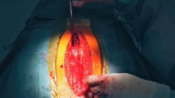 Requiere Disección Tórax Antes Realización Cirugía Corazón Abierto — Vídeos de Stock