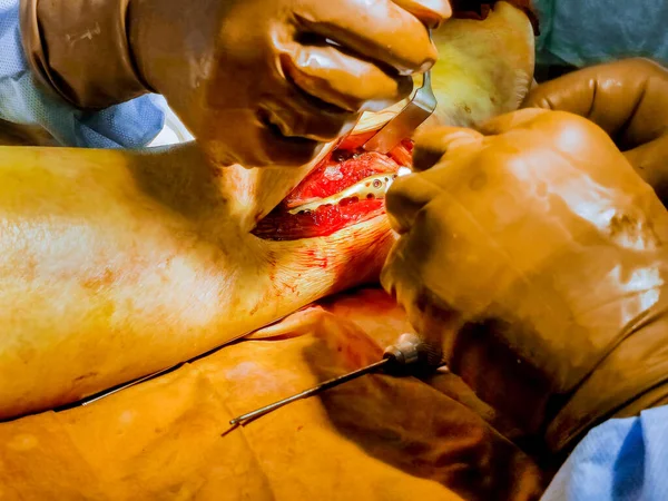 Händelse Benbrott Väljer Kirurger Att Implantera Metallplatta Genom Kirurgiska Ingrepp — Stockfoto
