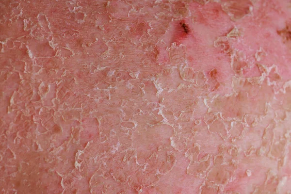 Eksim Psoriatik Adalah Kondisi Kulit Yang Berada Bawah Ranah Dermatologi — Stok Foto