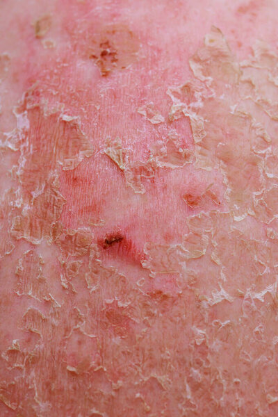 Dermatology professionals often encounter cases of psoriatic eczema in their practice.