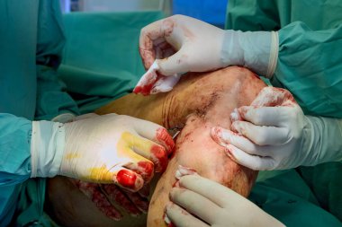 Hasta, yaralarını tedavi etmek için ortopedi uzmanları tarafından bacağından ameliyat oluyor..