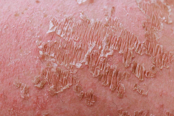 Gerenciar Eczema Psoriático Requer Conhecimento Especializado Campo Dermatologia — Fotografia de Stock