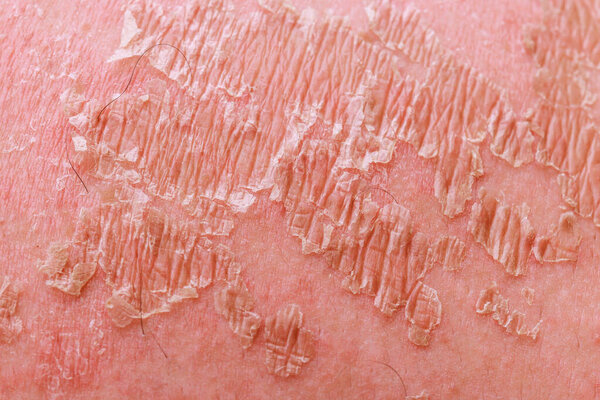 Psoriatic eczema dermatology a skin problems disease