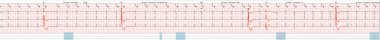 Elektrokardiyografi ECG test hastası kalp dalgasından bilimsel kardiyogramlar, kağıt üzerinde grafikler