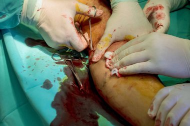 Hastanın aldığı yaralar için ortopedik cerrahların bacak ameliyatı yapması gerekiyor..