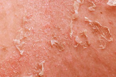Sedef hastalığı, dermatolojide çok disiplinli yaklaşım gerektiren karmaşık bir deri hastalığıdır..