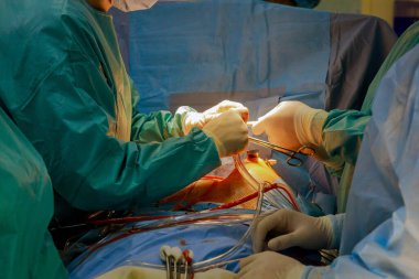 Kalp kapakçığı ameliyatı sırasında, hastanın genişletilebilir transkateter aortu alınır.