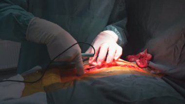 Yetenekli cerrah titizlikle ameliyat yapar, steril ortamda hastanın karnına odaklanır..
