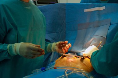 Cerrahlar ameliyat odasında cerrahi prosedür üzerinde çalışıyorlar. Ameliyat sırasında ciddi atmosfer hassasiyeti ve kardiyo takım çalışması..