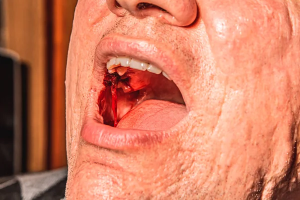 Close up man open mouth, jaw with teeth, detailed sealed bloody tooth after surgery in dental clinic. Tooth extraction treatment. Caries removing, nerve removal canals. Wisdom tooth, severe bleeding