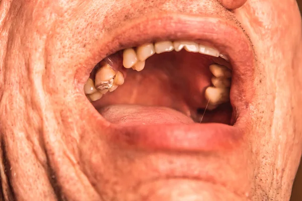 Close up man open mouth, jaw with teeth, detailed sealed tooth after surgery in dental clinic office. Tooth extraction treatment. Caries removing, nerve removal canals. Wisdom tooth