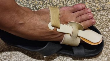 Ortopedik ayak pedi, insan ayağı, valgus hastalığı. Yüksek kalite fotoğraf