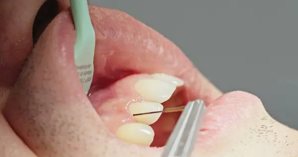 stock image Extreme Close-Up of Dentist Using Electronic Periodontal Probe. High quality 4k footage