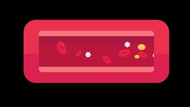 Атеросклероз Високим Рівнем Холестерину Викликає Високий Кров Яний Жир Грудні — стокове відео