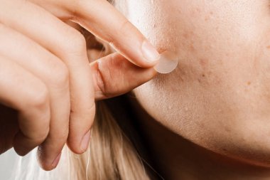 Sivilceli kız yanağında yuvarlak sivilce bandı var. Sivilce ve rosacea tedavisi için sivilce bandı kullanıyorum. Yüz gençleştirme, kozmetolojiyi temizleme.