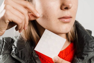 Sivilce ve rosacea tedavisi için sivilce bandı kullanan bir kadın. Yüz tazeleme, kozmetolojiyi temizleme. Sivilceli bir kız, yanağında yuvarlak sivilce bandı var.