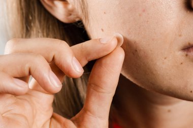 Sivilceli kız yanağında yuvarlak sivilce bandı var. Sivilce ve rosacea tedavisi için sivilce bandı kullanan bir kadın. Yüz gençleştirme, kozmetolojiyi temizleme.