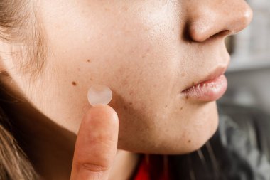 Sivilceli kız yanağında yuvarlak sivilce bandı var. Sivilce ve rosacea tedavisi için sivilce bandı kullanan bir kadın. Yüz gençleştirme, kozmetolojiyi temizleme.