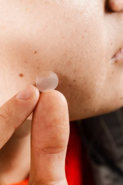 Sivilceli kız yanağında yuvarlak sivilce bandı var. Sivilce ve rosacea tedavisi için sivilce bandı kullanan bir kadın. Yüz gençleştirme, kozmetolojiyi temizleme.