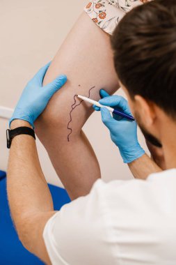 The phlebologist is marking legs before surgery to remove the veins. The vascular surgeon is marking leg veins. Vein markup