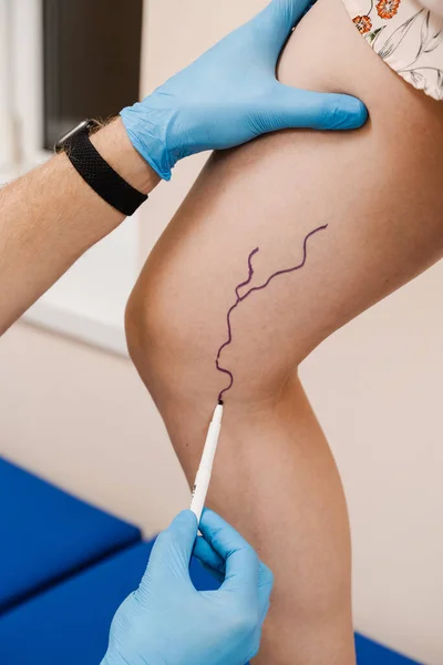The phlebologist is marking legs before surgery to remove the veins. The vascular surgeon is marking leg veins. Vein markup