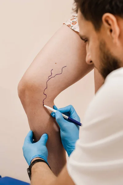 Vein markup. The phlebologist is marking legs before surgery to remove the veins. The vascular surgeon is marking leg veins