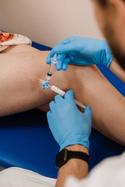 Sclerotherapy injecting into the varicose or spider vein on leg to treat blood vessel malformations. Vascular surgeon injects chemical solution into woman leg for sclerotherapy procedure
