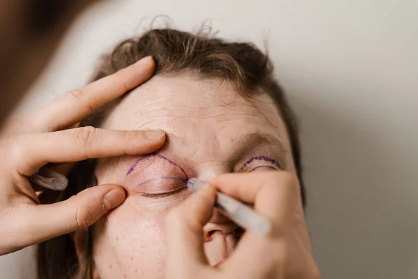 Blepharoplasty Markup Close Face Plastic Surgery Operation Modifying Eye Region — ストック写真