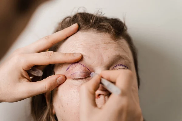 Blepharoplasty Markup Close Face Plastic Surgery Operation Modifying Eye Region — ストック写真