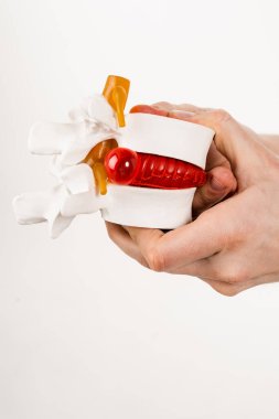 Beyaz arka planda omurgalar arası fıtık olan bel fıtığı modeli. Omurilik fıtığı ya da osteokondrosis hastalığı