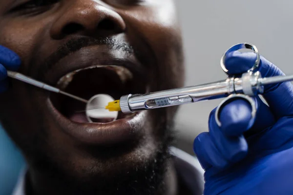 Anesthesia syringe injection close-up. Dentist injects syringe with anesthesia in mouth of african man for treatment of diseased teeth. Caries treatment