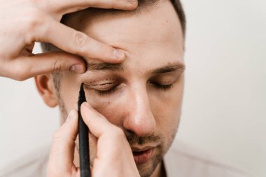Erkek blefaroplasti, adam artışı için. Estetik cerrah, klinikteki göz bölgesini değiştirmek için estetik ameliyat öncesi göz kapağına işaretler çizer.