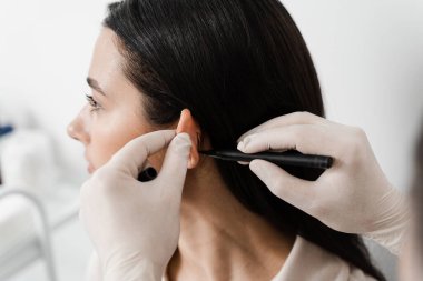 Otoplasty markup for surgical reshaping of the pinna, or outer ear for correcting an irregularity and improving appearance. Surgeon doctor marking girl ear before otoplasty cosmetic surgery clipart