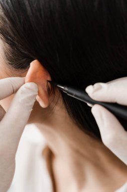 Kulak ameliyatından önce göz kapağı ameliyatı. Cerrah otoplasti estetik ameliyatından önce kulağına işaret koymuş. Pinna ve kulak cerrahi yeniden şekillendirme için Otoplasty işareti