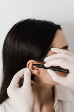 Ameliyat doktoru otoplasti estetik ameliyatından önce kızın kulağını işaretliyor. Pinna cerrahi yeniden şekillendirme için Otoplasty işaretleme, ya da düzensizlik düzeltmek ve görünümünü iyileştirmek için dış kulak