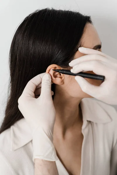 Surgeon doctor marking girl ear before otoplasty cosmetic surgery. Otoplasty markup for surgical reshaping of the pinna, or outer ear for correcting an irregularity and improving appearance