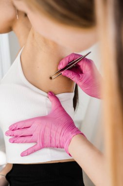 Dermatolog, melanom ve deri kanseri intikamı için kızın benini ya da doğum lekesini inceliyor. İyi huylu köstebekleri kontrol ediyorum. Deri nakli ve genç kadının lezyonları inceleniyor.