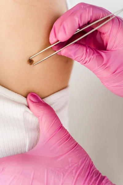 Close Examination Skin Neoplasm Lesions Young Woman Checking Benign Moles Stock Photo