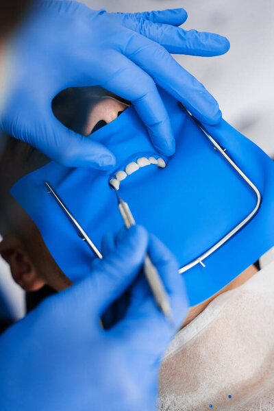 Dental dam installation in mouth by dentist. Doctor applies dental dam to isolate teeth of patient