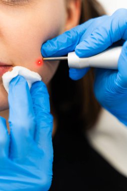 Kızın yüzündeki doğum lekelerini lazerle silme işlemi. Mavi eldivenler, beyaz kızın derisindeki benleri temizlemek için lazer kozmetoloji cihazı kullanıyor.