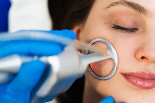 stock image Process of facial CO2 laser resurfacing. Cosmetologist removes wrinkles and scars using laser from face of attractive girl