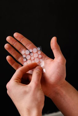 Yüzündeki iltihaplı sivilceleri iyileştirmek için sivilce çıkartması. Sivilcelerdeki tahriş olmuş deriyi temizlemek için dermatolojik sivilce bandı. Sivilceler için etkili tıbbi olmayan tedavi