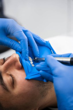 Diş kliniğinde sondaj yapmadan önce diş fırçası hazırlığı. Dişçi sondaj için dişleri ayırmak için kauçuk baraj kullanıyor.