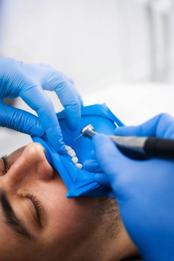 Diş kliniğinde sondaj yapmadan önce diş fırçası hazırlığı. Dişçi sondaj için dişleri ayırmak için kauçuk baraj kullanıyor.