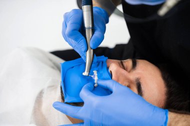 Diş hekimi, dişleri kaplama kurulumuna hazırlamak için diş barajını kullanır. Diş kaplamaları hazırlanıyor