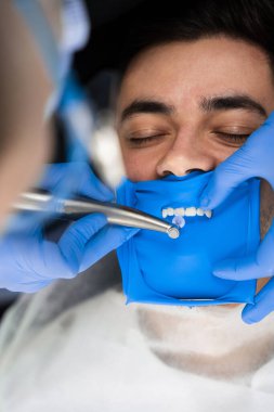 Diş hekimi, dişleri kaplama kurulumuna hazırlamak için diş barajını kullanır. Diş kaplamaları hazırlanıyor