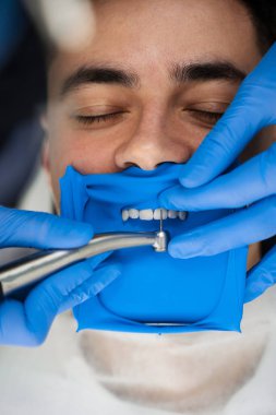 Diş kaplamaları hazırlanıyor. Diş hekimi, dişleri kaplama kurulumuna hazırlamak için diş barajını kullanır.