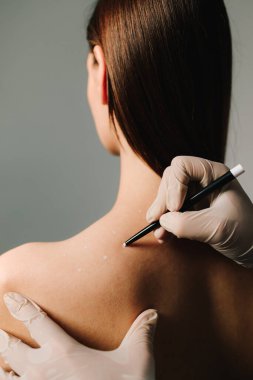 Migren tedavisi için deri hazırlama. Baş ağrısı ve ağrı kesicilerin tedavisi. Doktor tarafından migren tedavisi için işaretlenmiş deri